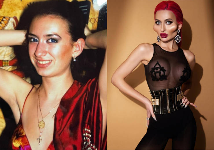 Before And After “Beauty” Fillers…