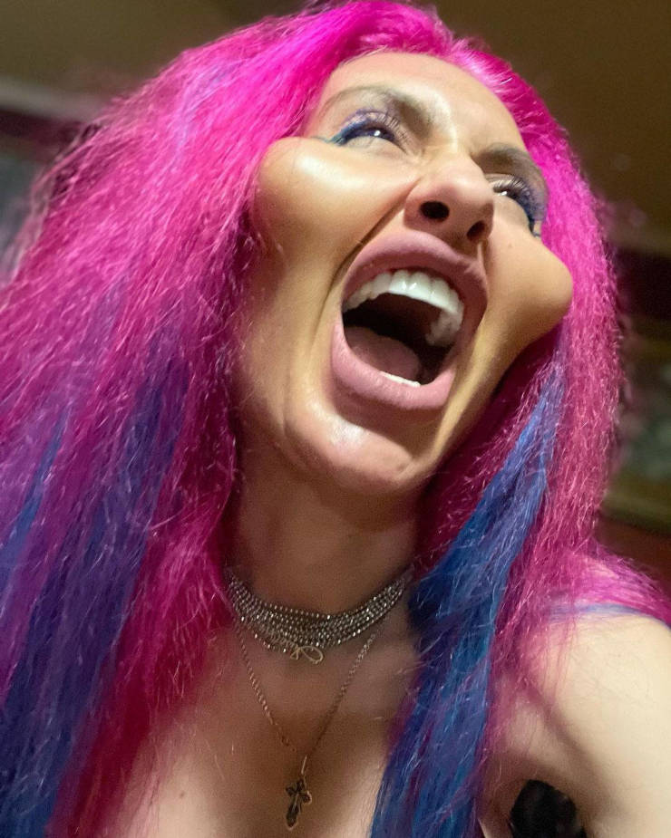 Before And After “Beauty” Fillers…