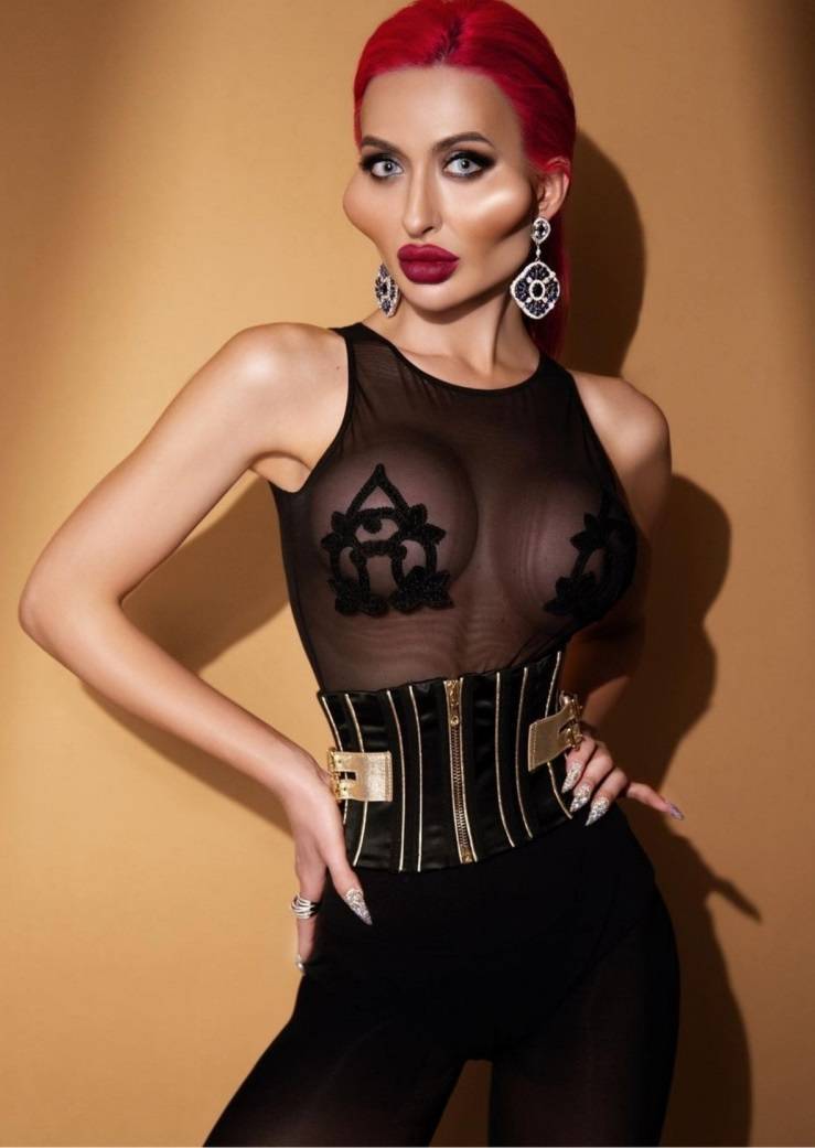 Before And After “Beauty” Fillers…