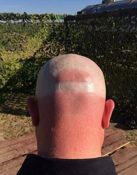 When Sunbathing Goes Wrong…