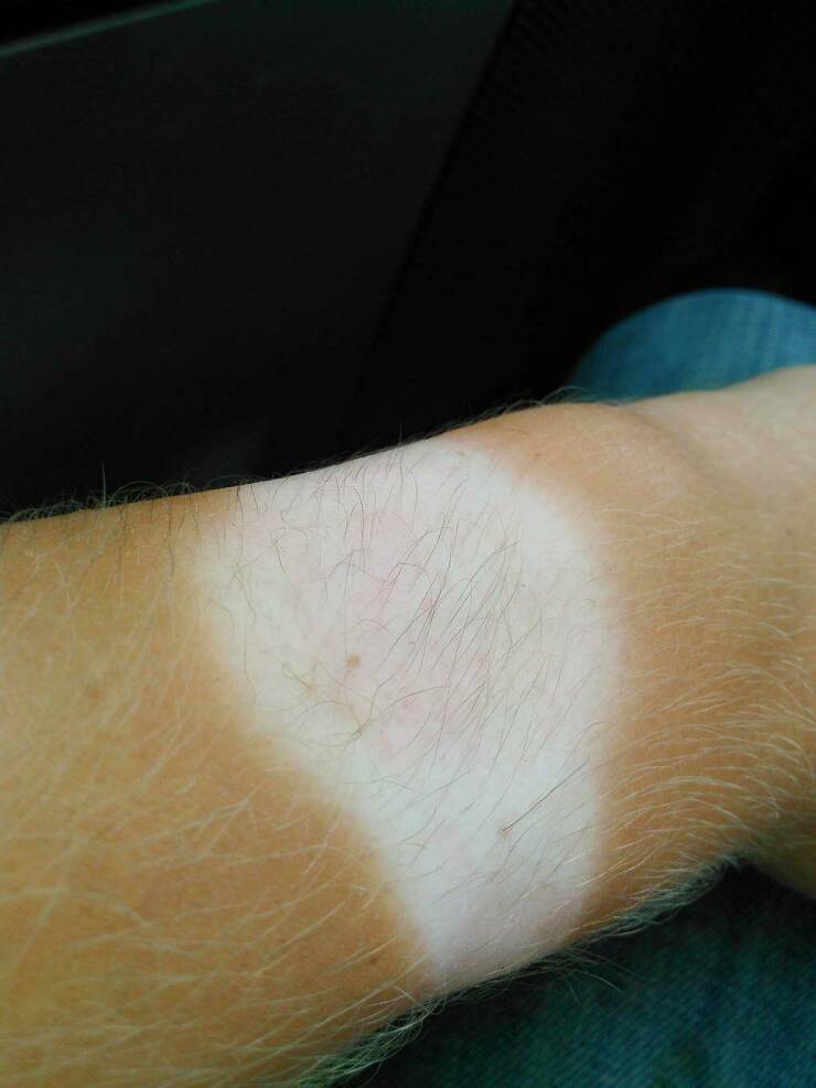 When Sunbathing Goes Wrong…