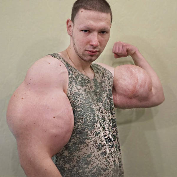 Synthol Does NOT Look Good, Guys…