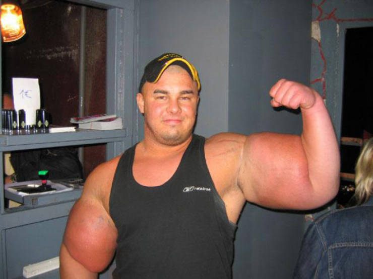 Synthol Does NOT Look Good, Guys…