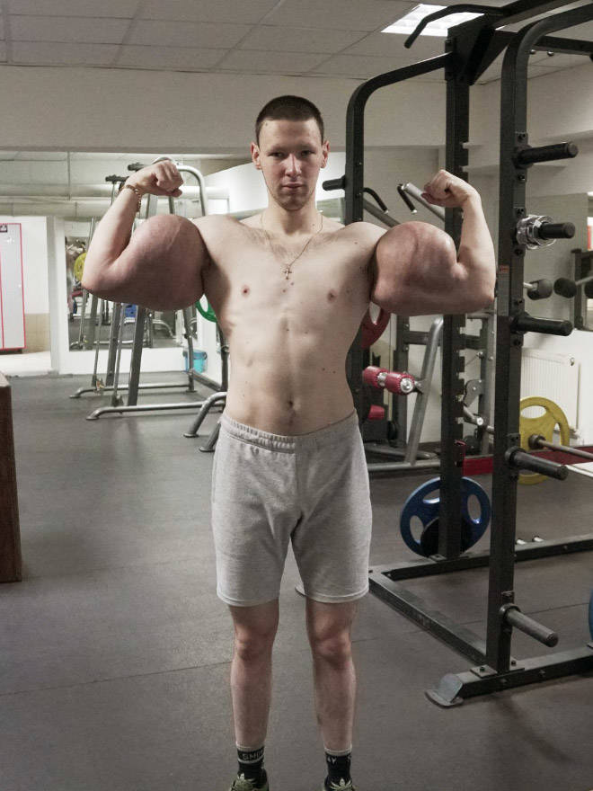 Synthol Does NOT Look Good, Guys…