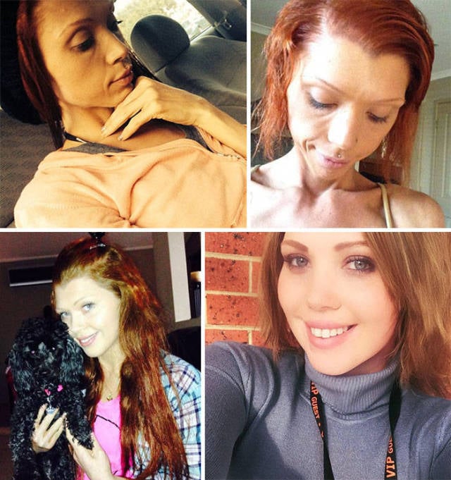 Anorexia Is Not The Final Verdict!