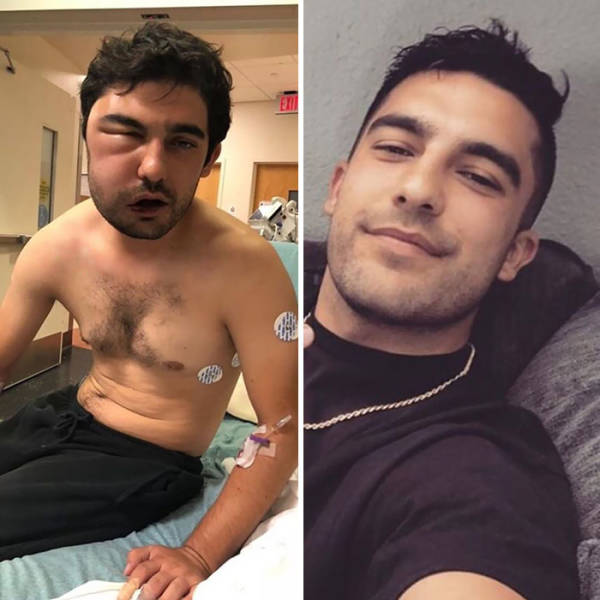 How Drug Addiction Looks Before And After