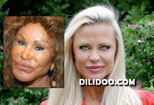 When plastic surgery fails (38 pics)