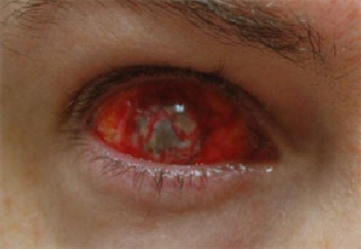 Eerie Eyeball Covers