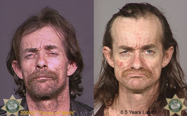Meth Addicts: Before and After