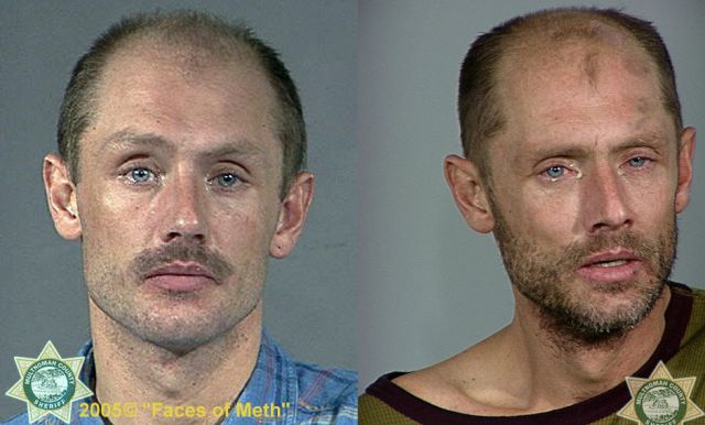 Meth Addicts: Before and After