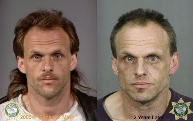 Meth Addicts: Before and After