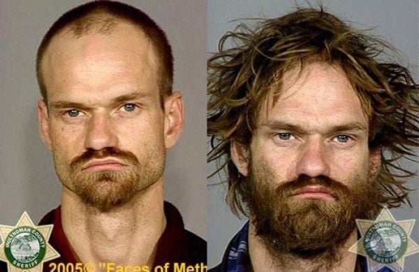 Meth Addicts: Before and After