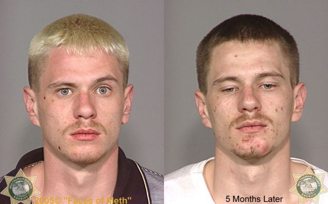 Meth Addicts: Before and After