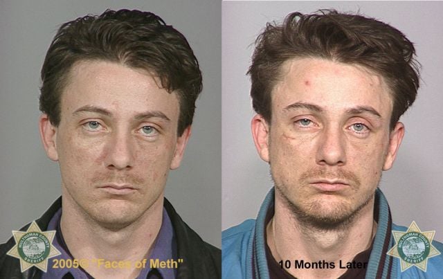 Meth Addicts: Before and After