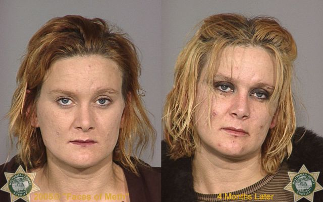 Meth Addicts: Before and After