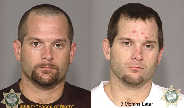 Meth Addicts: Before and After