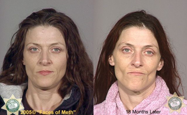 Meth Addicts: Before and After