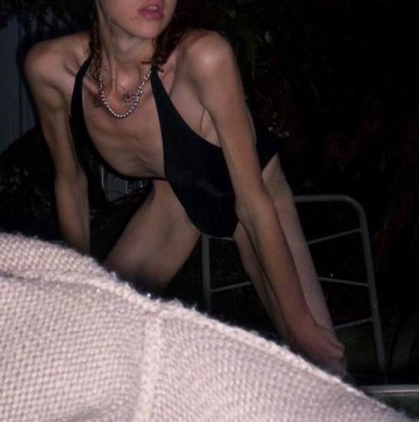 Anorexic Girls