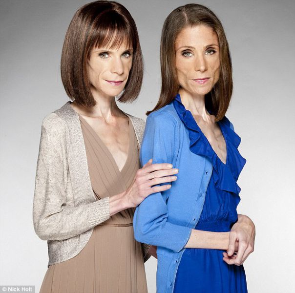 Anorexic Twins Disturbing Pact