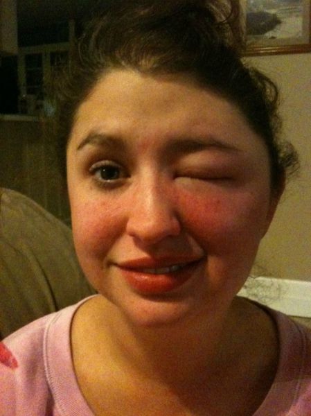 What a Brown Recluse Spider Bite Looks Like