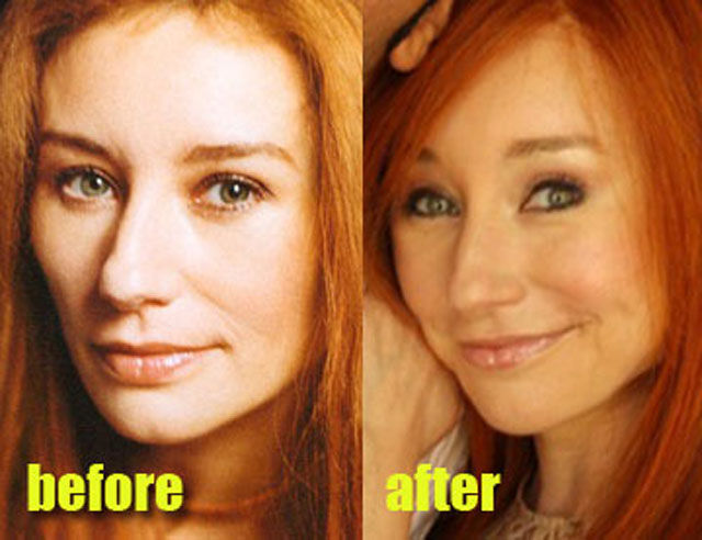 Celebrity Plastic Surgery Before & After