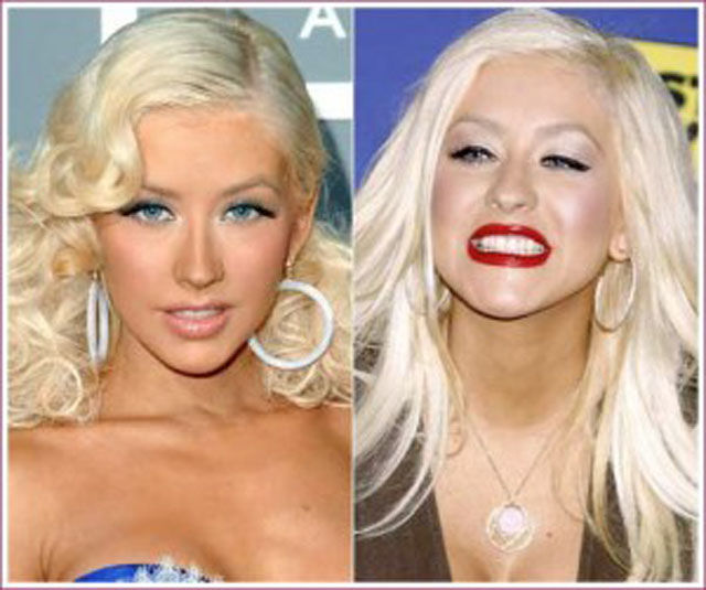 Celebrity Plastic Surgery Before & After