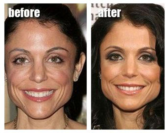 Celebrity Plastic Surgery Before & After