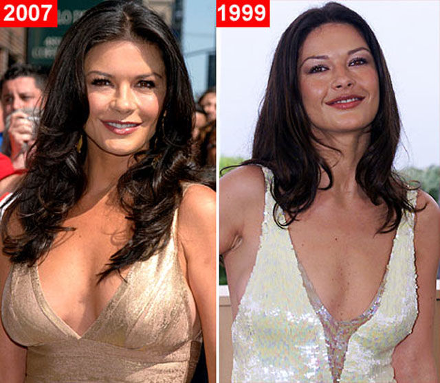 Celebrity Plastic Surgery Before & After