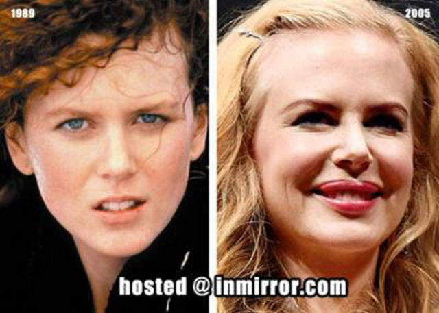Celebrity Plastic Surgery Before & After
