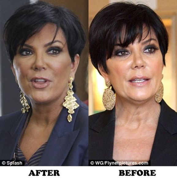 Celebrity Plastic Surgery Before & After