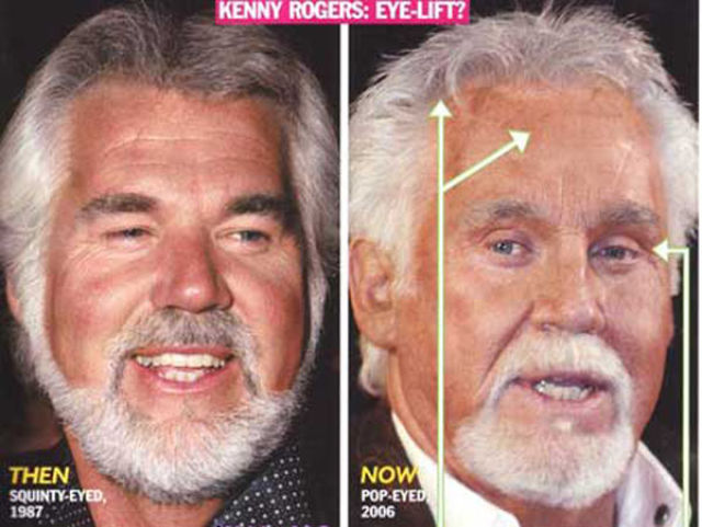 Celebrity Plastic Surgery Before & After