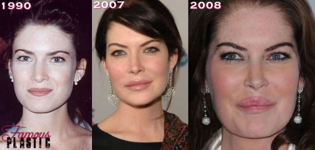 Celebrity Plastic Surgery Before & After