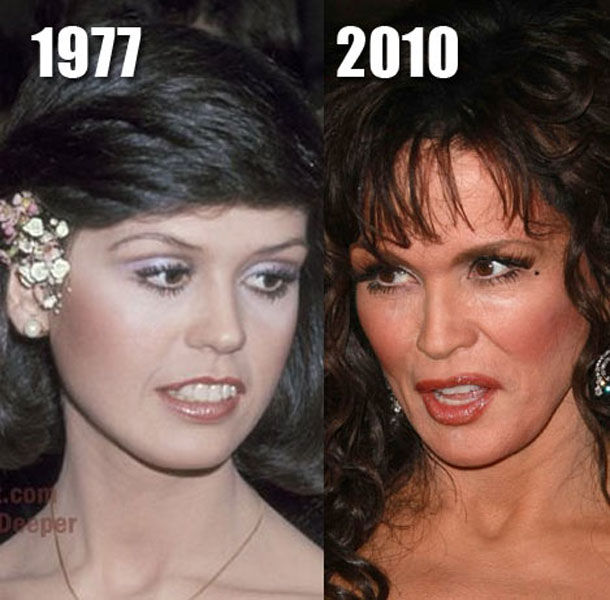 Celebrity Plastic Surgery Before & After