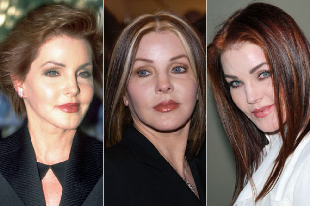 Celebrity Plastic Surgery Before & After