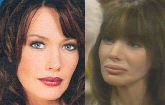 Celebrity Plastic Surgery Before & After