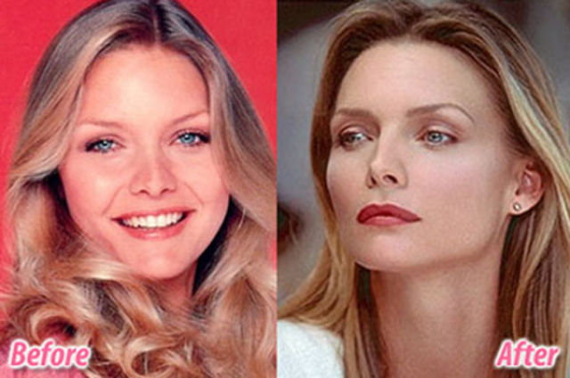Celebrity Plastic Surgery Before & After