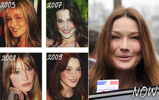 Celebrity Plastic Surgery Before & After