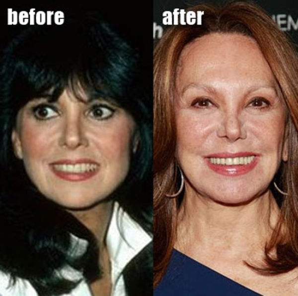 Celebrity Plastic Surgery Before & After