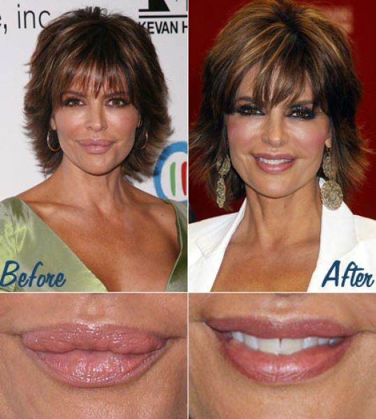Celebrity Plastic Surgery Before & After
