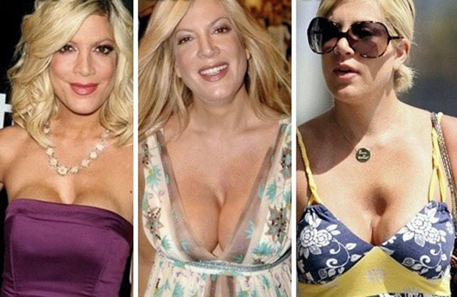 Celebs with the Worst Fake Breasts: Before and After
