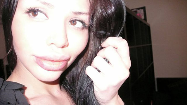 Ladies With Silicone Overdose