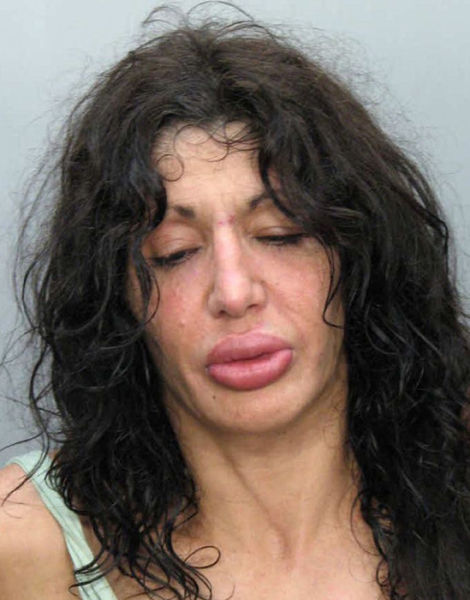 Ladies With Silicone Overdose