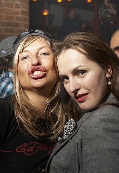 Ladies With Silicone Overdose