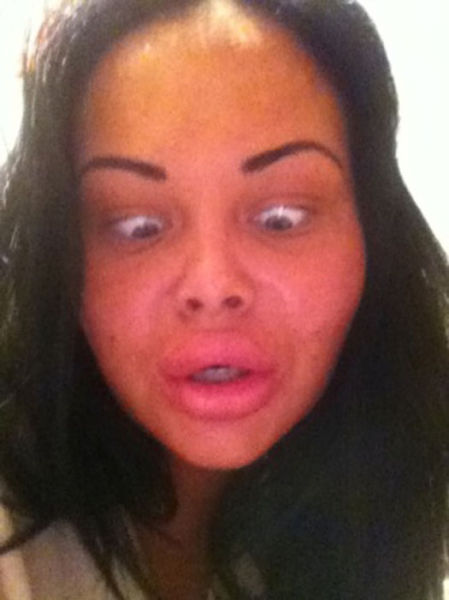 Ladies With Silicone Overdose