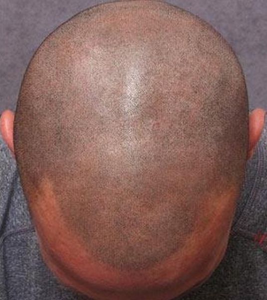 The ‘No Hair’ Solution!