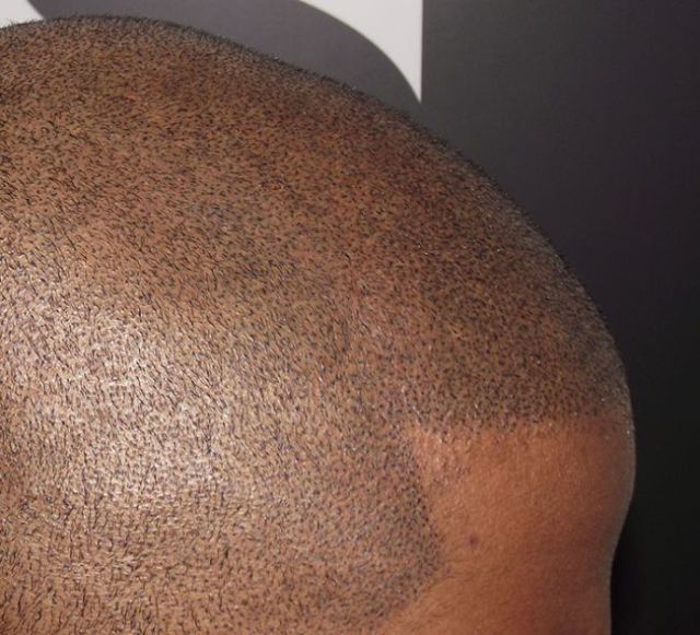 The ‘No Hair’ Solution!