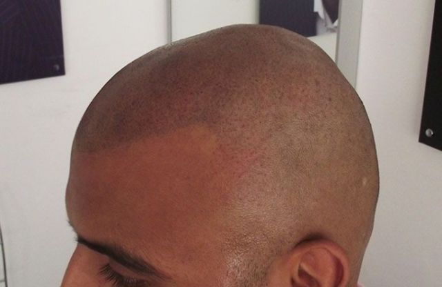 The ‘No Hair’ Solution!