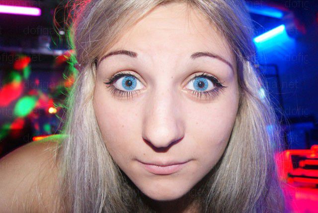 Before and After: Girl Gets a Dramatic Lip Enhancement