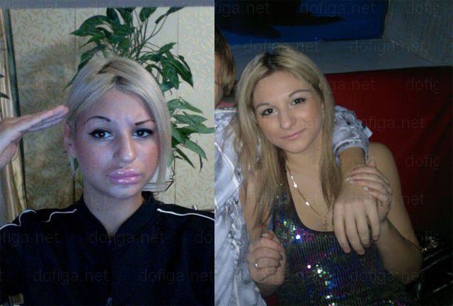 Before and After: Girl Gets a Dramatic Lip Enhancement