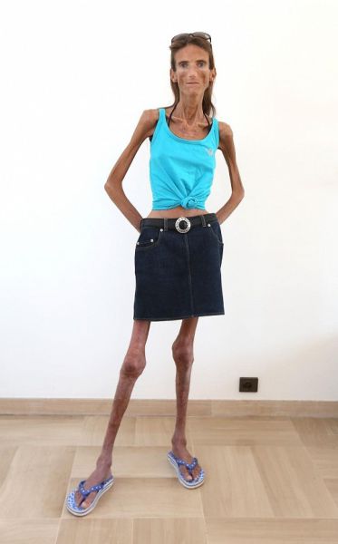 Her Dream Body Is Killing Her